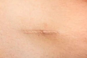 Close-up  of a scar that can be treated with neural therapy