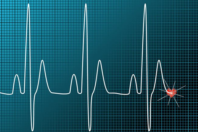 Heart Waves - Ozone Therapy affect the ejection fraction in the heart