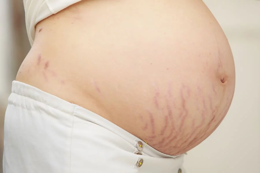 Closeup image with a C-section. We offer neural scar therapy