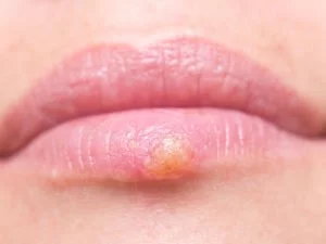 Image of a patient's swollen lips, because of herpes