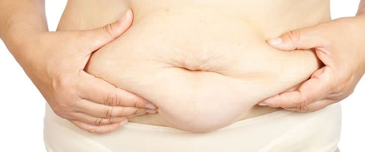 Image of a patient suffering from obesity. We treat obesity with ozone therapy and other alternative treatments