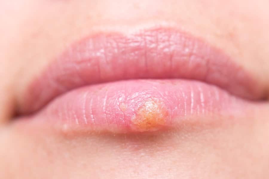 Lips of a woman suffering from Herpes HSV1. We offer Herpes HSV1 & HSV2 Natural Treatment