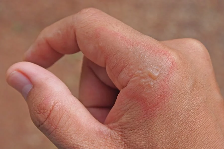 Image of the hand of a person suffering from Impetigo