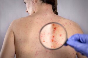 Image of a back of a woman suffering from shingles