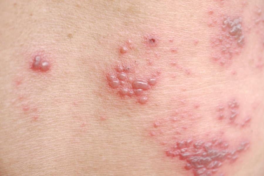Closeup of an inflamed shingles rash that needs natural treatment for shingles
