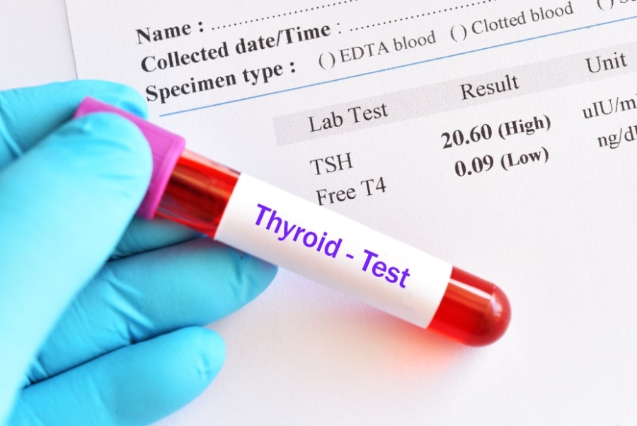 Thyroid testing can diagnose HyperThyroidism or HypoThyroidism