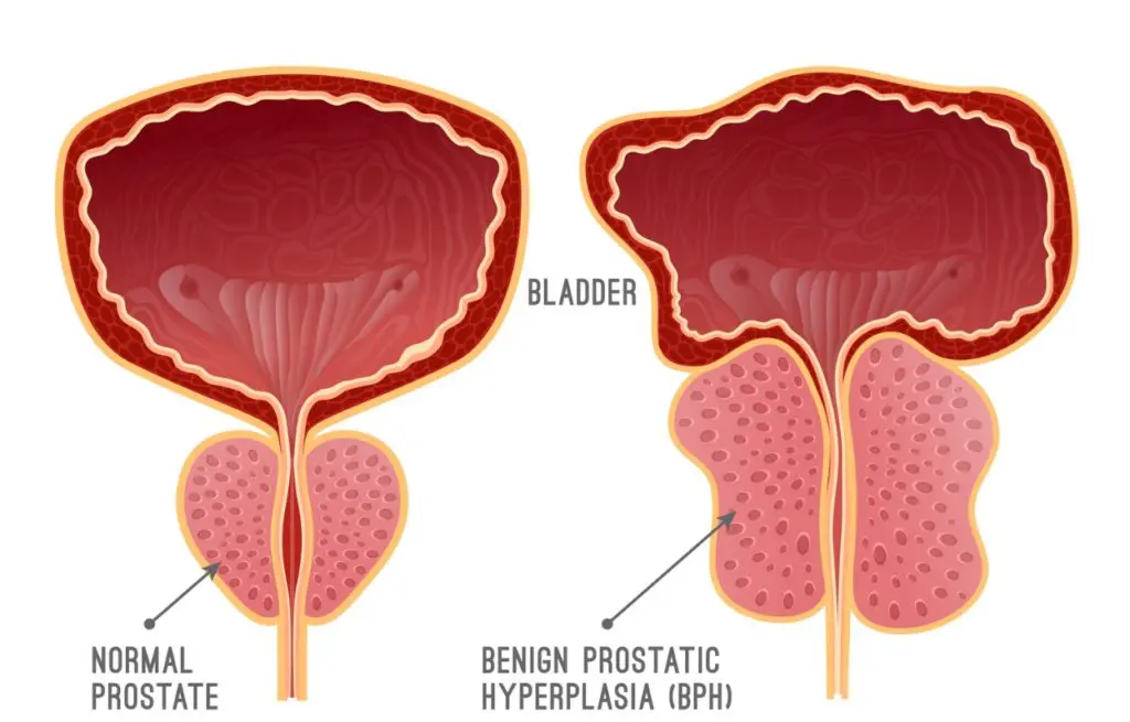 Learn about natural treatment options for Benign Prostatic Hyperplasia (BPH) from LifeWorks Wellness Center, the top natural health clinic in the US.
