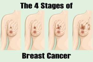 The Four Stages of Breast Cancer
