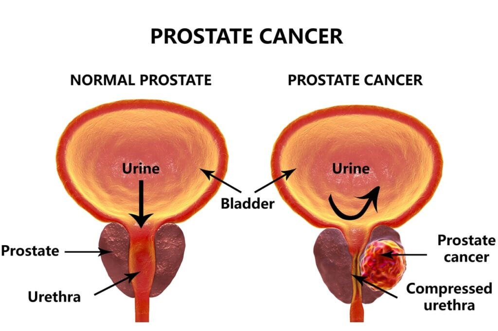 Diagram of normal prostate vs prostate with cancer