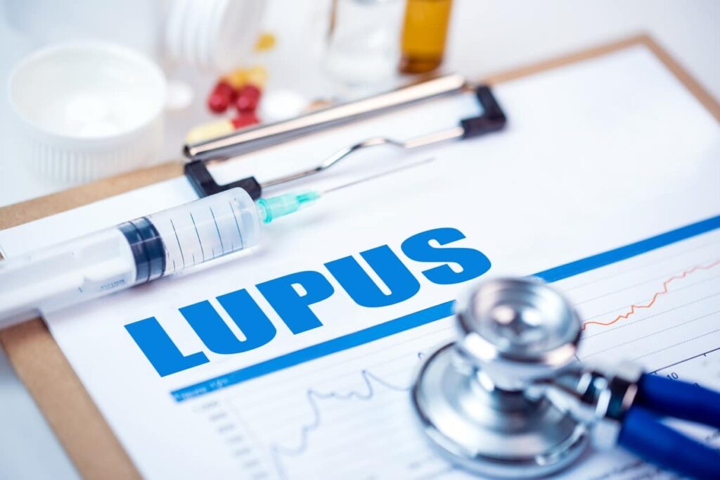 Lupus test results