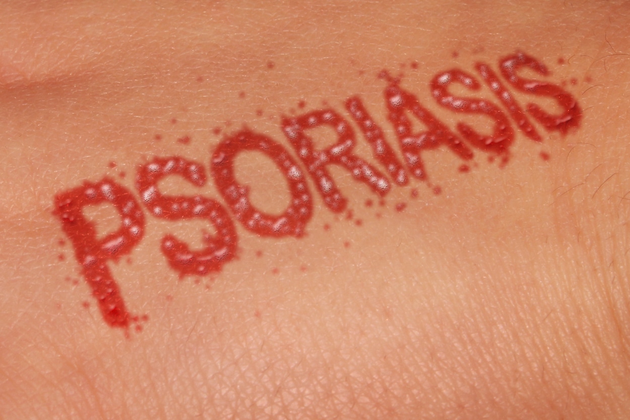 Psoriasis autoimmune disease , red patchy skin shown in the word Psoriasis